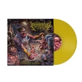 Embryectomy Vitriolic Baptism (LP)